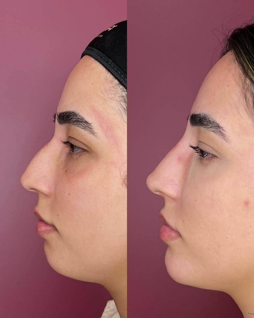 Harmonização facial