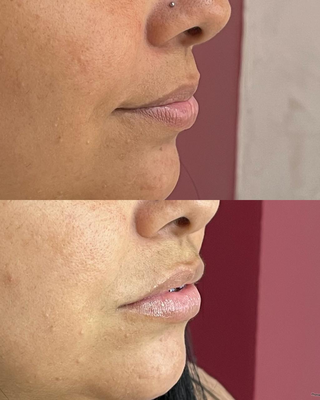 Harmonização facial