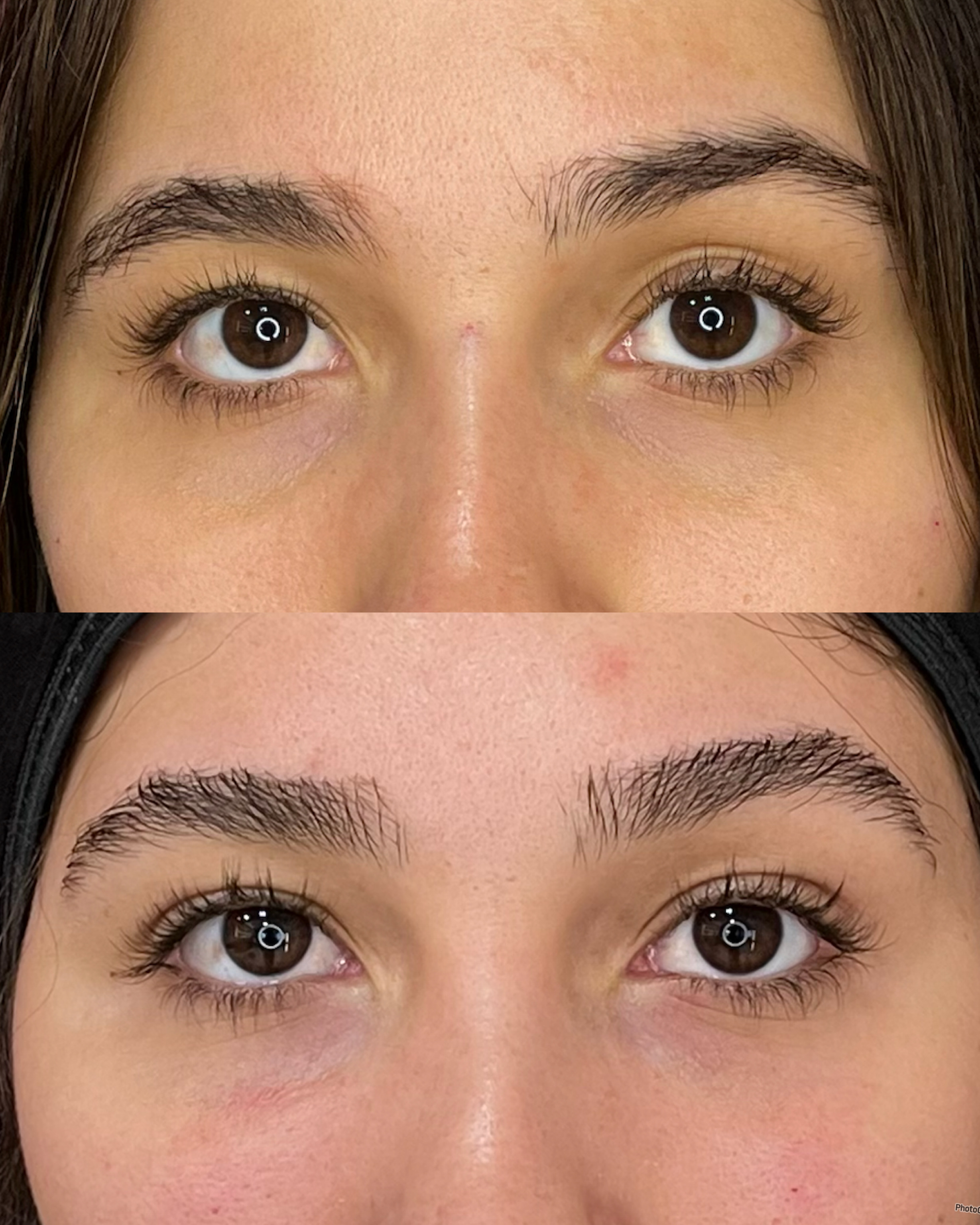 Harmonização facial